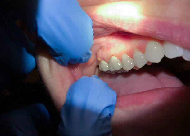 Best Same-Day Emergency Dentist in Unt Vernon, MO