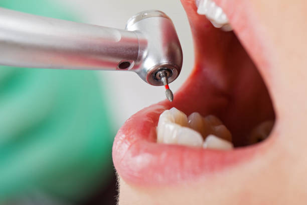 Best Emergency Wisdom Teeth Removal in Unt Vernon, MO